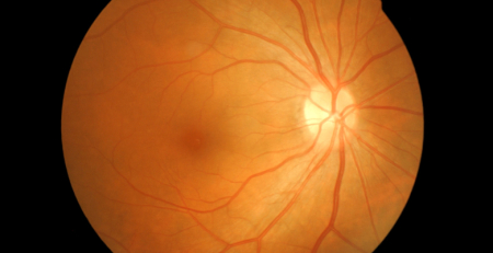 Terapêutica demonstra eficácia com intervalos de tratamento alargados na oclusão da veia retiniana