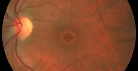 EURETINA 2020: Tratamento de buracos e pseudoburacos maculares